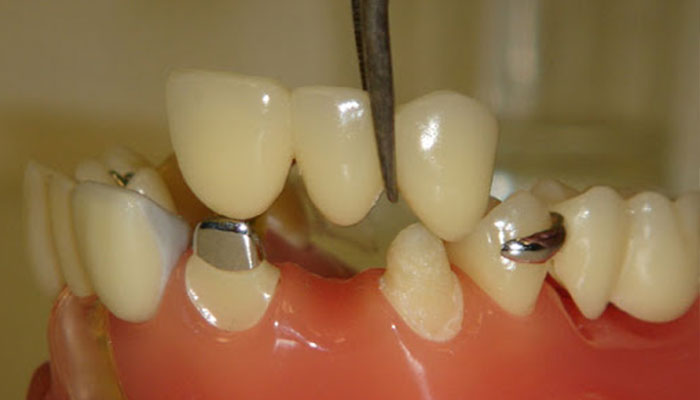 dental crown and bridges at goklani's cosmetic and dental clinic aurangabad