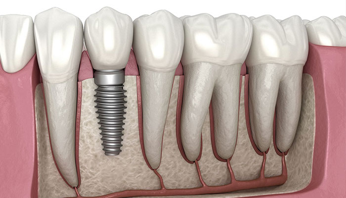 dental implants at goklani's cosmetic and dental clinic aurangabad