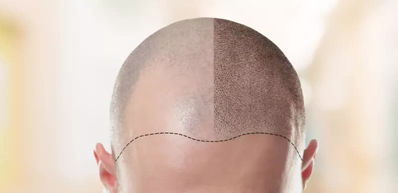 hair transplantation at goklani's cosmetic and dental clinic aurangabad