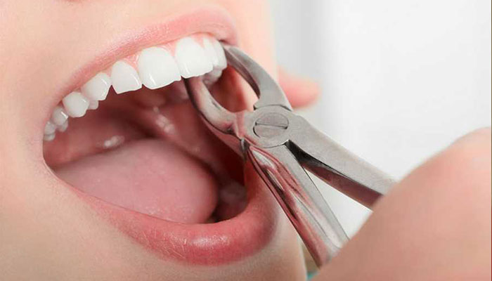 tooth extraction at goklani's cosmetic and dental clinic aurangabad